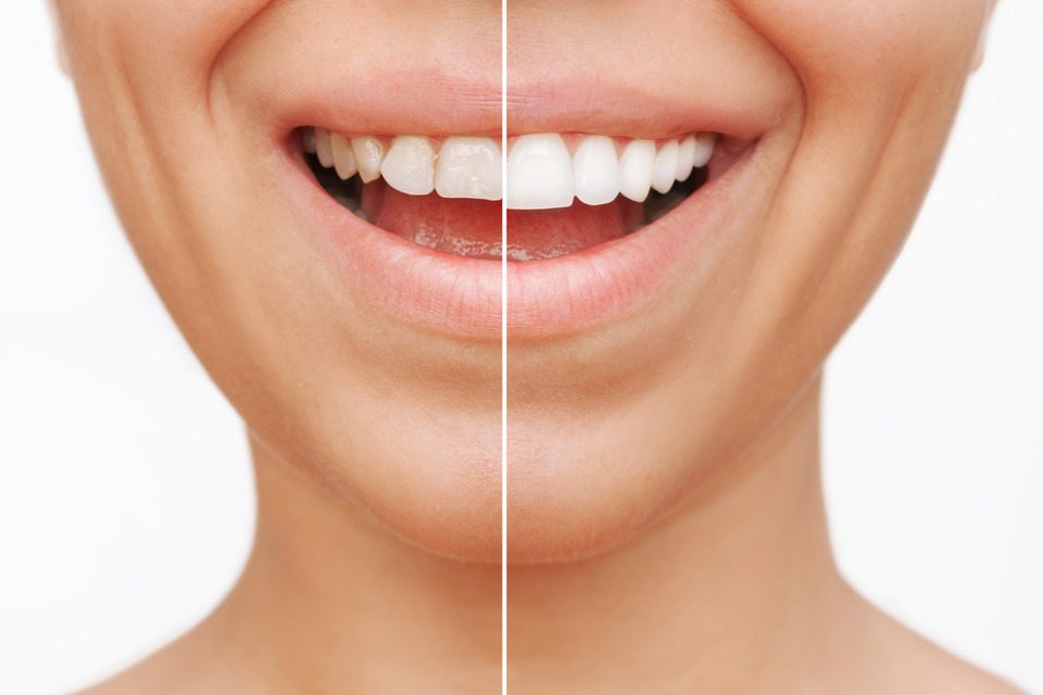 zdjęcie zębów przed i po bondingu